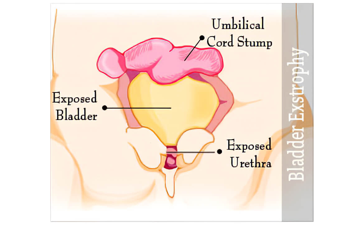Meilleur urologue pédiatrique en Inde, urologie pédiatrique robotique